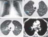 lung3